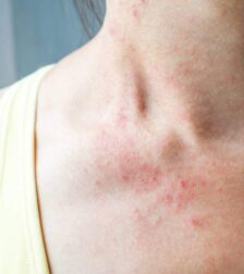 media-les-box-par-abonnement-pour-apaiser-les-peaux-eczemateuses