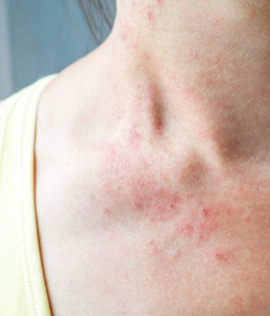 media-les-box-par-abonnement-pour-apaiser-les-peaux-eczemateuses