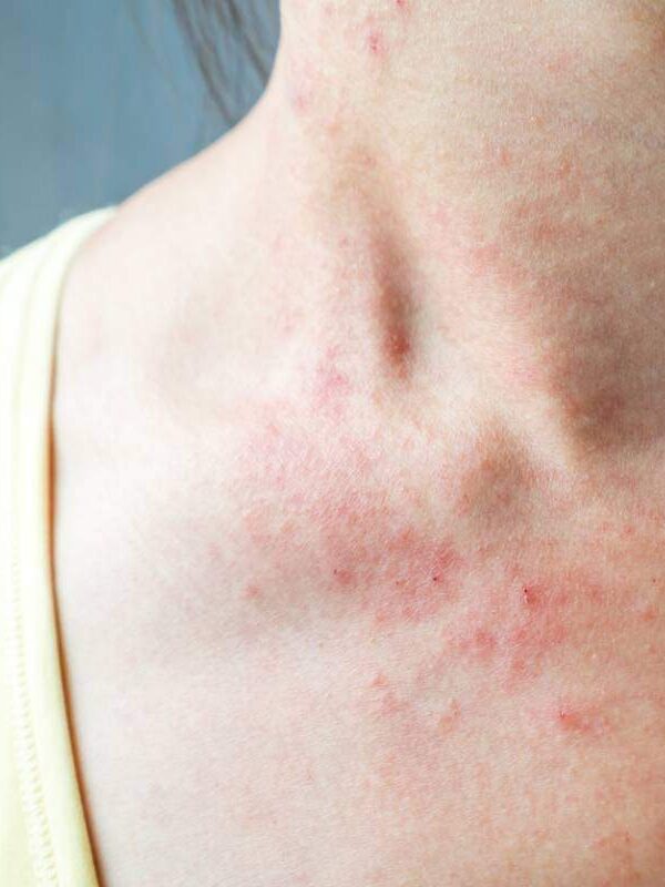 media-les-box-par-abonnement-pour-apaiser-les-peaux-eczemateuses